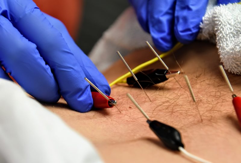 Dry Needling Therapy At Greg Ott Physical Therapy Center 4071